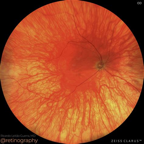 ocular albinism retinography