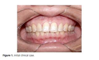 Perimolysis: case report