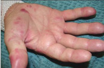 Extracardiac Manifestations Flashcards | Quizlet