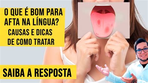 Afta Na Lingua Como Tratar - O que é bom para afta na língua ? causas e dicas de como tratar - YouTube