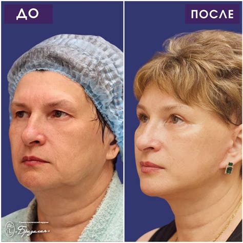Фейслифтинг