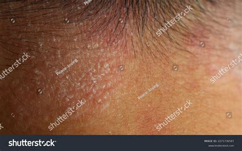Psoriasis Skin Disease Causes Rash Itchy Stock Photo 2271736587 ...