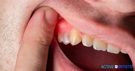 The Potential Complications of Wisdom Tooth Removal