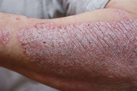 Plaque Psoriasis Demystified: An Overview | Pharma Giant