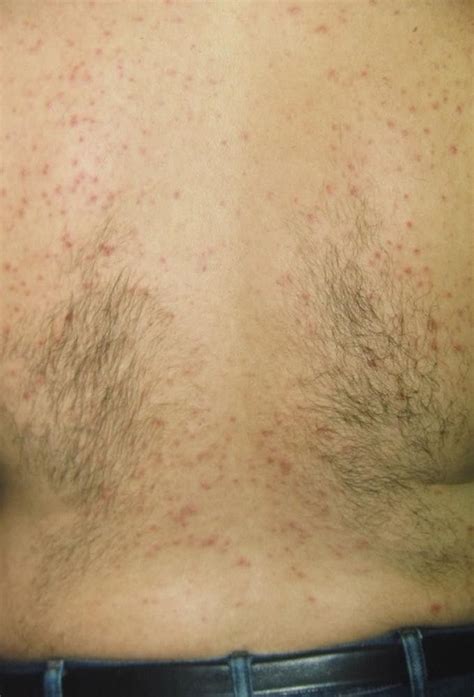 Image:Miliaria Rubra (Prickly Heat)-Merck Manual Professional Edition