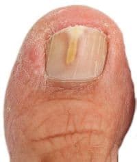 toenail-fungus-early-stages | Podocity Ayak Sağlığı Ayak Bakımı ve ...