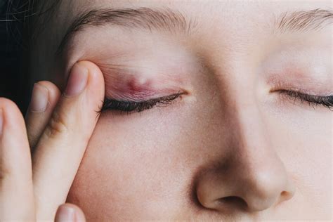 What Is Chalazion? Causes, Symptoms and Treatment - DYZ Eye Hospital