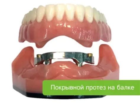 Протезирование на имплантах