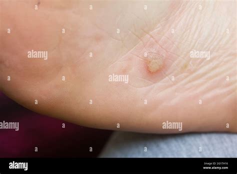 14 Most Usual Symptoms Of Dyshidrotic Eczema Page 2 O - vrogue.co
