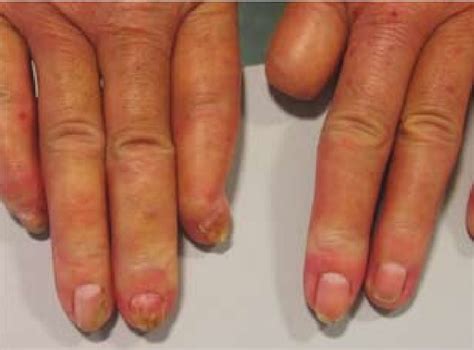 Crest Syndrome