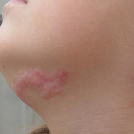 scar tissue    procedure  scientific diagram