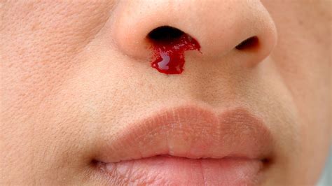 Bleeding Nose
