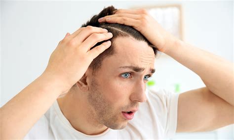 how to know your balding
