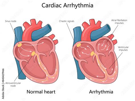 poster normal heart  cardiac arrhythmia showing sinus node