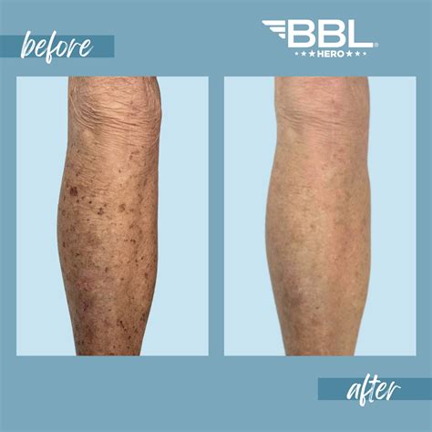 Sophie Rain's BBL:  Before & After - Is It Worth It?