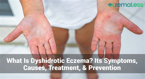 What Is Dyshidrotic Eczema? Its Symptoms, Causes, Treatment ...