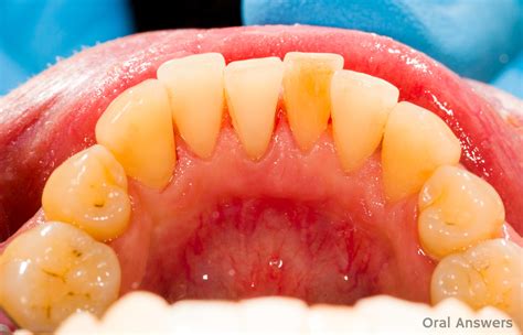 how to remove tartar from teeth without dentist 11