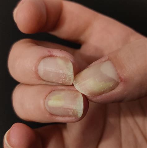 After two treatments of Terbinafine, still getting worse : r/NailFungus