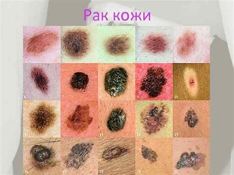 Передозировка ультрафиолетом Ультрафиолет Часть спектра солнечного
