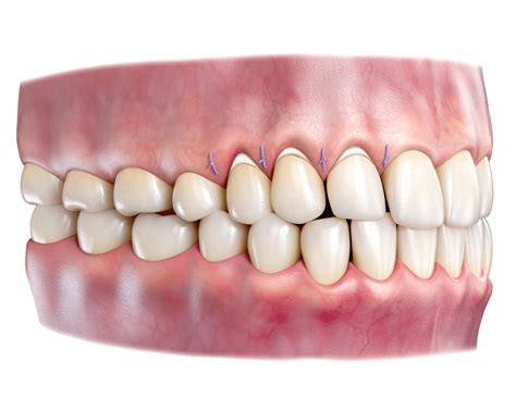 Gum Graft & Rejuvenation - Premier LA Periodontics & Dental Implant Center