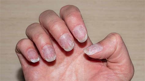 care  nail fungus