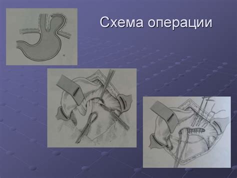 Диафрагмальные грыжи, ахалазия кардии, дивертикулы пищевода, химические ...