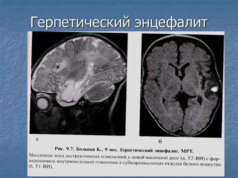 Лучевая дифференциальная диагностика очаговых поражений головного мозга ...