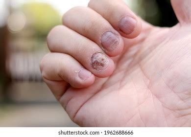 Fungus Hand: Over 24,366 Royalty-Free Licensable Stock Photos ...
