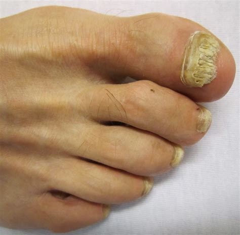 Fungal Nails Point Cook, Altona Meadows, Tarneit | Low Level Laser Therapy