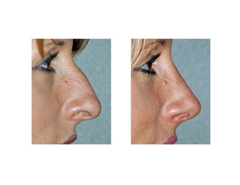 nasal tip rotation  projection  rhinoplasty explore plastic surgery