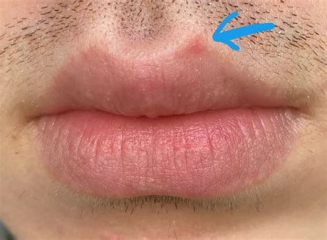 Whitehead Pimple On Lip