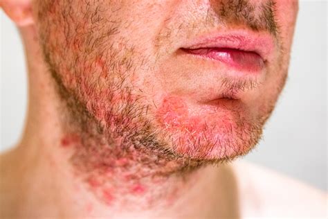 FOLICULITE: SAIBA COMO TRATAR – Clínica Ideal