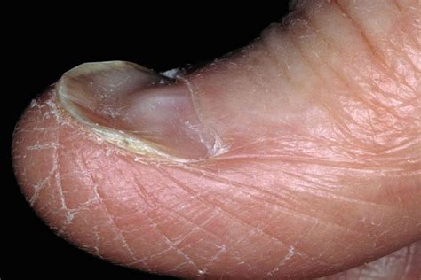 Anemia Nails: How They Look, Causes, and Treatments