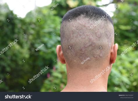 Seborrheic Dermatitis Inflammatory Changes Skin Scalp Stock Photo ...