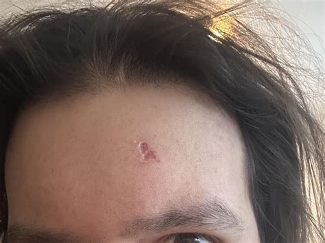 Scab is off, huge crater scar visible - anything I can do now to reduce