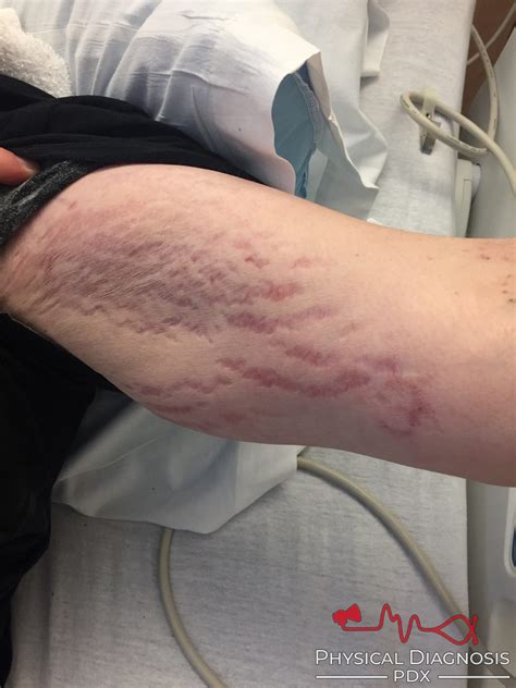 Abdominal Striae - Physical Diagnosis PDX