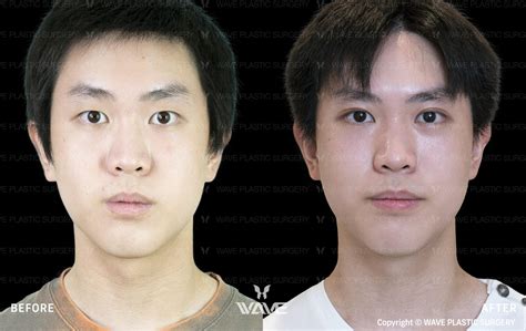 Before And After Plastic Surgery Korean Men