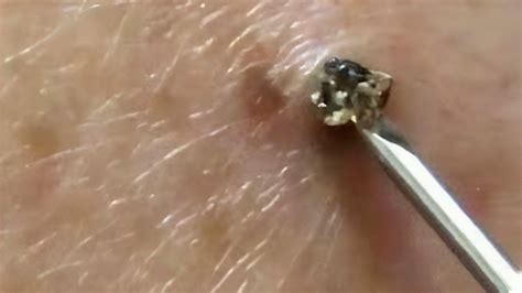 Big Cystic Acne Blackhead, Extraction Blackheads & Milia #237 ...