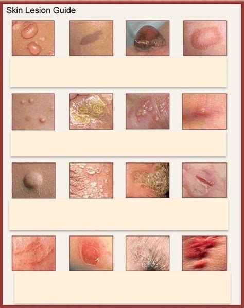 Dermatology - Lesions Diagram | Quizlet