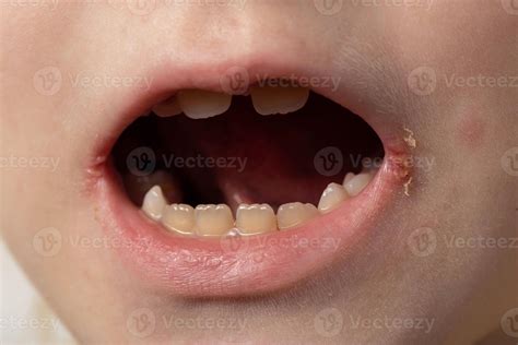 Pain and itching in the corners of the lips of a girl's mouth. Seizures