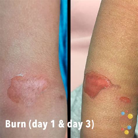 What Is The Burn On Skin at Louise Collier blog