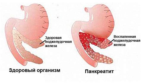 Алкогольный панкреатит: симптомы, лечение и профилактика