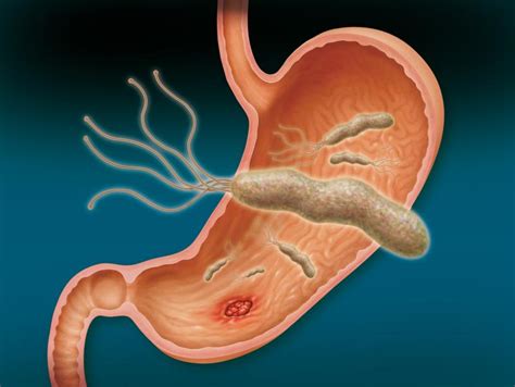 Top 7 Homeopathic Medicines for H.Pylori Infection - Homeopathy at ...