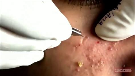 Pimple Popping Videos 2024 Blackheads Removal Youtube - Lina Shelby