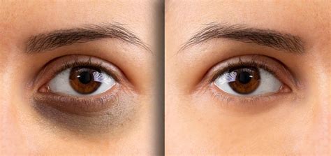 eye dark circles treatment  dwarka delhi delhi laser clinic