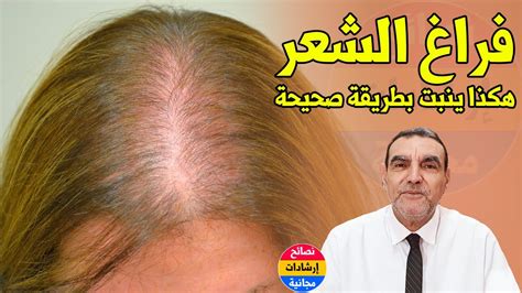 الطريقة الصحيحة لإنبات فراغات الشعر المتساقط مع الدكتور محمد الفايد ...