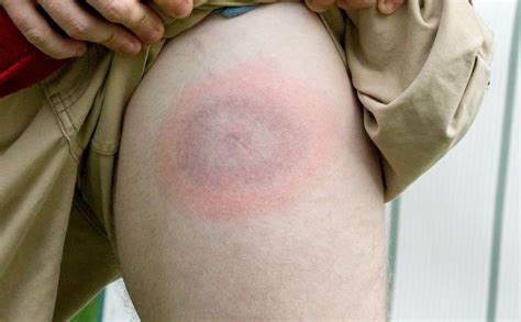 Borelioza z Lyme – objawy, leczenie i skuteczna profilaktyka przed