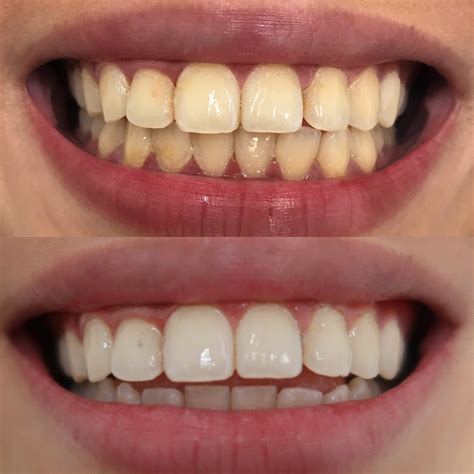 How to Remineralize Teeth & Strengthen Your Enamel Naturally