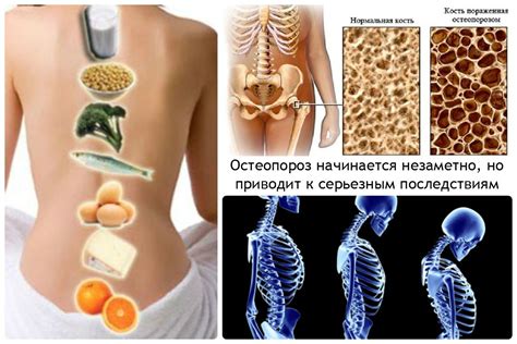 Остеопороз: причины, симптомы, лечение