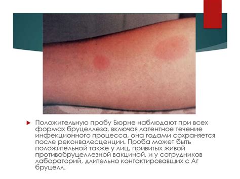 Бруцеллез. Диагностика. Классификация - презентация онлайн